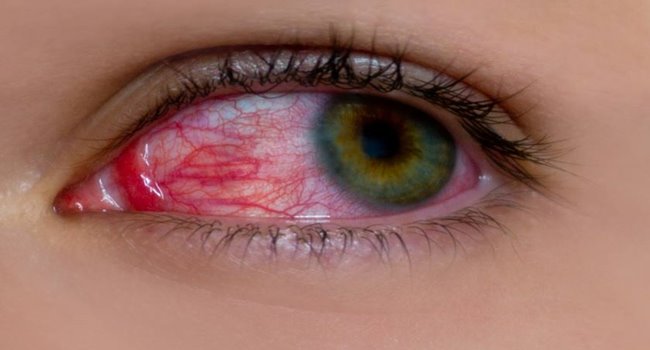 conjuntivite-olhos