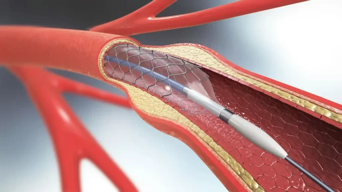 angioplastia-coronariana-reduz-mortes-acelera-alta-hospitalar Ilustração de uma angioplastia coronária, procedimento que reduz mortes e acelera a alta hospitalar, com instalação de stent para desobstrução das artérias do coração.
