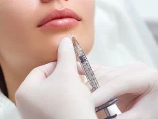 Aplicação de preenchimento facial com PMMA em procedimento estético, mostrando uma seringa próxima aos lábios de uma paciente.
