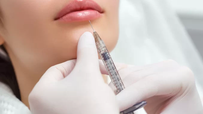 aplicacao-preenchimento-facial-pmma-jpg Aplicação de preenchimento facial com PMMA em procedimento estético, mostrando uma seringa próxima aos lábios de uma paciente.
