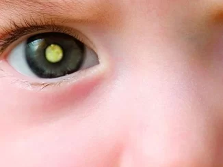 Close-up do olho de uma criança mostrando reflexo branco que pode indicar doenças graves em crianças, destacando a importância de atenção médica.
