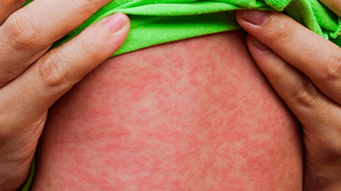 Imagem destacada - Brasil confirma 37 casos de sarampo em 2025 e amplia vacinação