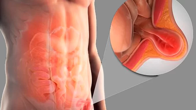 Caroço na virilha pode indicar hérnia inguinal e exigir cirurgia, como ilustrado na imagem com representação do intestino e detalhes anatômicos.