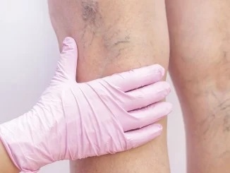 Imagem de uma mão de luva de procedimento médico tocando a parte de trás da coxa de uma pessoa, exibindo veias varicosas visíveis, ilustrando a importância de cuidar cedo das varizes para recuperar saúde, rotina e autoestima.