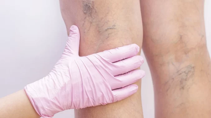 Imagem de uma mão de luva de procedimento médico tocando a parte de trás da coxa de uma pessoa, exibindo veias varicosas visíveis, ilustrando a importância de cuidar cedo das varizes para recuperar saúde, rotina e autoestima.