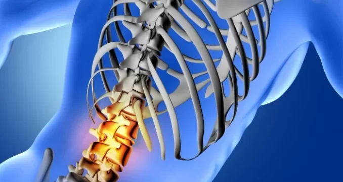 Imagem ilustrativa de uma coluna vertebral com destaque na lesão na região cervical, relacionada ao teste de polilaminina aprovado pela Anvisa para tratar lesões medulares.