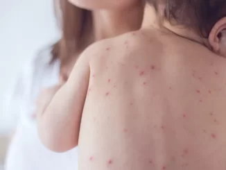 Bebê com múltiplas manchas de sarampo nas costas, ilustrando o primeiro caso confirmado em São Paulo em 2026, com uma pessoa ao fundo.