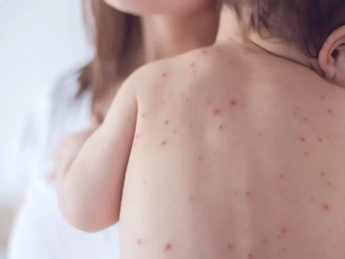 Bebê com múltiplas manchas de sarampo nas costas, ilustrando o primeiro caso confirmado em São Paulo em 2026, com uma pessoa ao fundo.