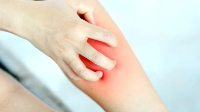 Imagem destacada - Coceira crônica nas pernas pode indicar risco de doença venosa